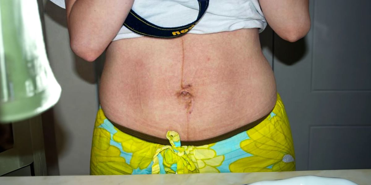 Stretch marks: My Husband's Humiliation and My MIL's Lesson